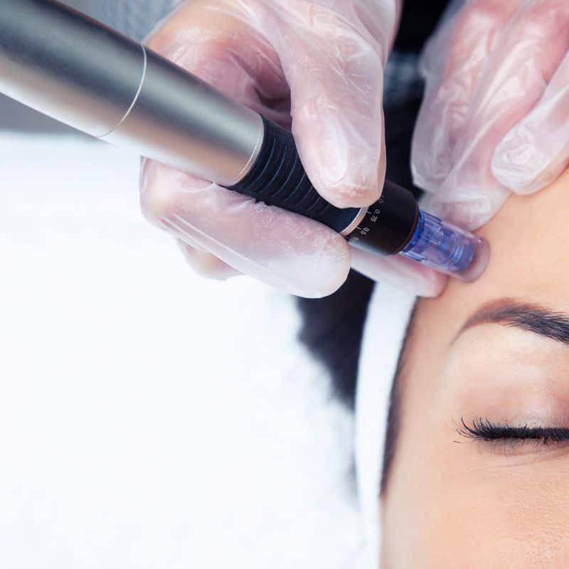 Morpheus8 treatment West Tilbury from Lipo Sculpt - Book in today!