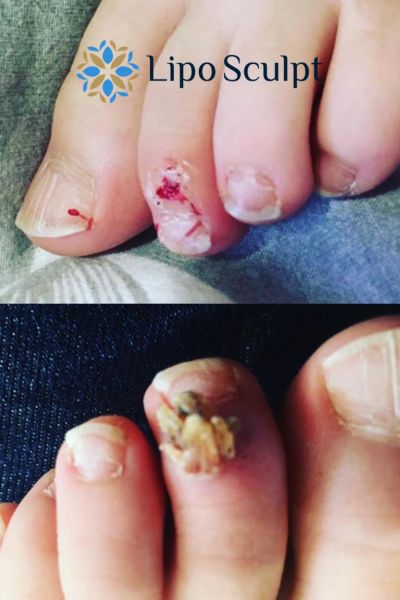 Wart removal customer results from Lipo Sculpt West Tilbury